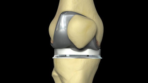 Total Knee Replacement