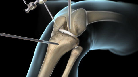 Anterior Cruciate Ligament (ACL) Surgery