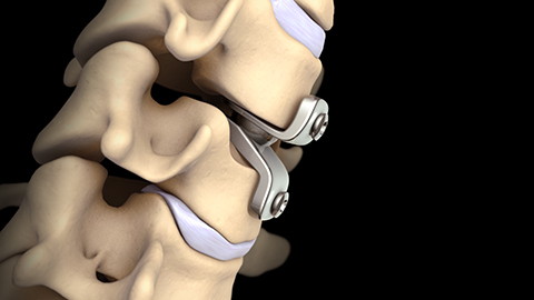 Cervical Disc Replacement